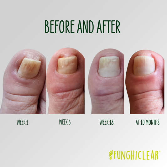 How to Apply Toenail Fungus Spray for Best Results