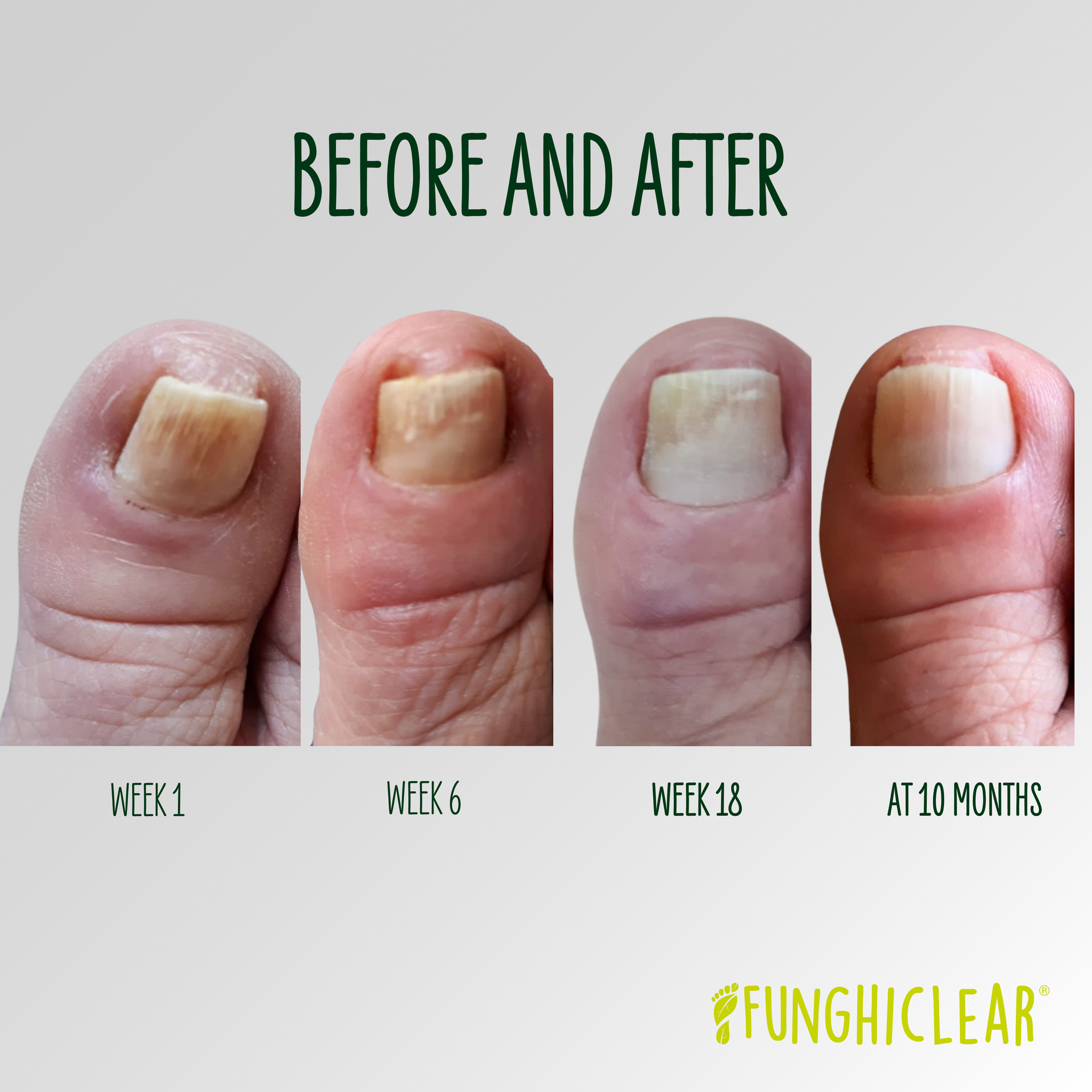 Progression with FunghiClear Treatment